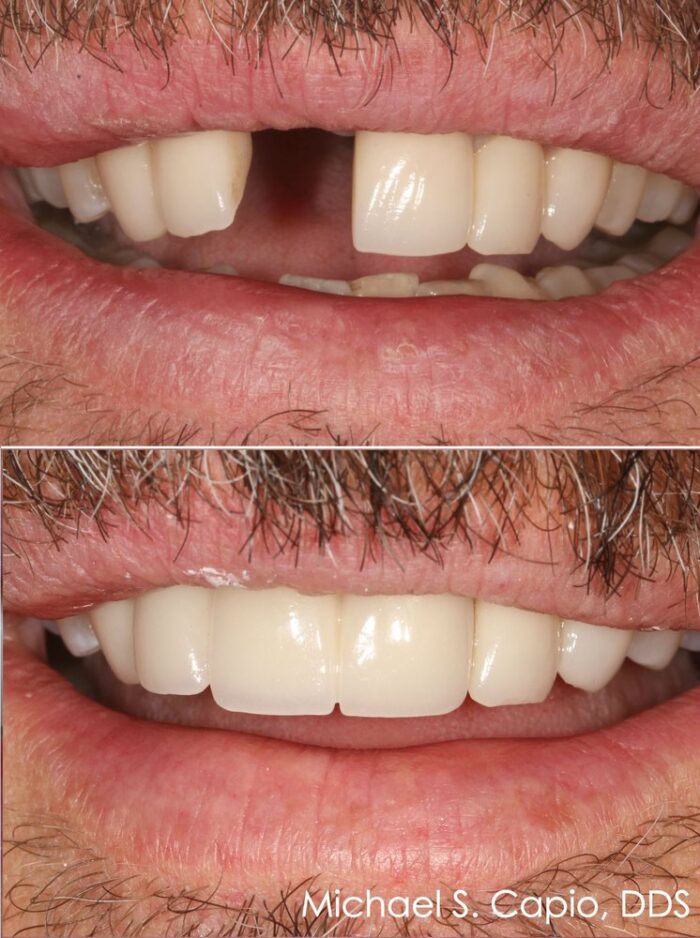 Cosmetic Tooth Replacement Bridge - Dr Michael Capio 90045