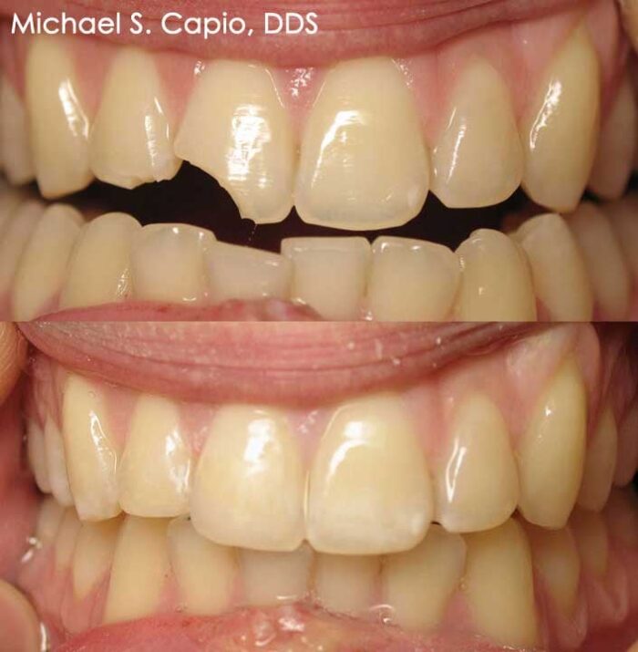 Cosmetic Bonding and Veneers Westchester 90045 Dr Michael Capio