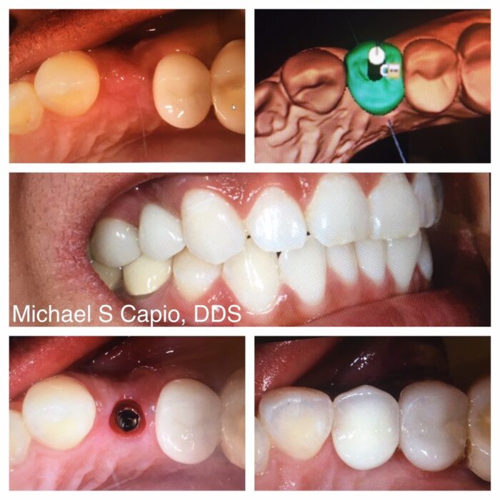Digital Guided Implant Surgery - Dr Michael Capio - 90045
