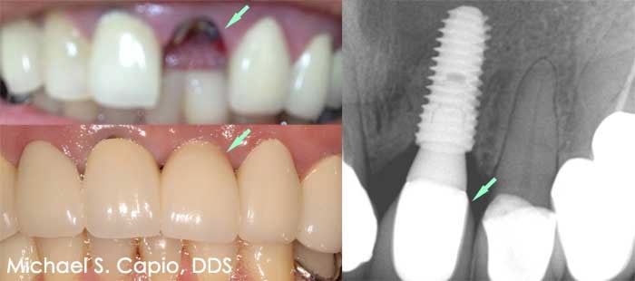 Immediate Implant Placement - Dr Michael Capio Westchester